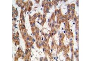 IHC analysis of FFPE human hepatocarcinoma tissue stained with PHB antibody