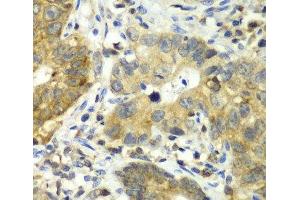 Immunohistochemistry of paraffin-embedded Human gastric cancer using DPP3 Polyclonal Antibody at dilution of 1:100 (40x lens). (DPP3 抗体)