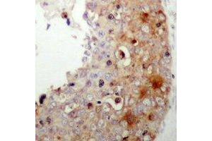 Immunohistochemical analysis of XIAP (pS87) staining in human prostate cancer formalin fixed paraffin embedded tissue section. (XIAP 抗体  (pSer87))
