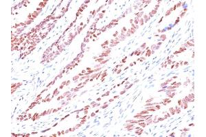 Formalin-fixed, paraffin-embedded human Colon Carcinoma stained with p57 Monoclonal Antibody (KP10). (CDKN1C 抗体)