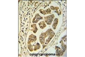 HCCS Antibody (Center) (ABIN653839 and ABIN2843103) IHC analysis in formalin fixed and paraffin embedded colon carcinoma followed by peroxidase conjugation of the secondary antibody and DAB staining. (HCCS 抗体  (AA 173-200))
