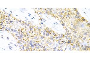 Immunohistochemistry of paraffin-embedded Human esophageal cancer using PPP2R4 Polyclonal Antibody at dilution of 1:200 (40x lens).