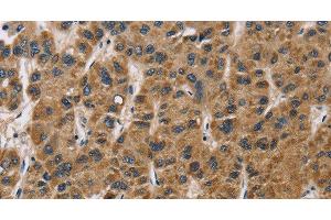 Immunohistochemistry of paraffin-embedded Human liver cancer tissue using IL19 Polyclonal Antibody at dilution 1:40 (IL-19 抗体)
