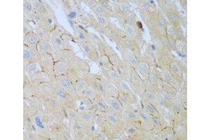 Immunohistochemistry of paraffin-embedded Human liver cancer using CEACAM7 Polyclonal Antibody at dilution of 1:100 (40x lens). (CEACAM7 抗体)
