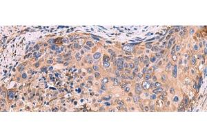 Immunohistochemistry of paraffin-embedded Human cervical cancer tissue using GUSB Polyclonal Antibody at dilution of 1:50(x200) (Glucuronidase beta 抗体)
