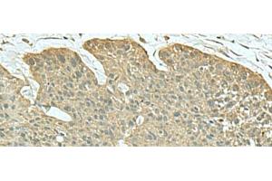 Immunohistochemistry of paraffin-embedded Human esophagus cancer tissue using FN3KRP Polyclonal Antibody at dilution of 1:55(x200) (FN3KRP 抗体)