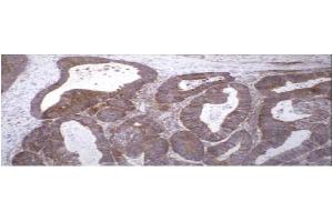 Immunohistochemical staining of human colon carcinoma tissue using TIMP-2 antibody . (TIMP2 抗体)