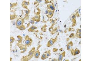 Immunohistochemistry of paraffin-embedded Human liver cancer using BTD Polyclonal Antibody at dilution of 1:100 (40x lens). (BTD 抗体)