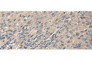Immunohistochemistry of paraffin-embedded Human liver cancer tissue using ZG16 Polyclonal Antibody at dilution of 1:95(x200) (ZG16 抗体)