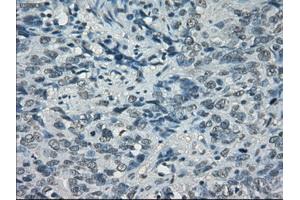 Immunohistochemical staining of paraffin-embedded Carcinoma of bladder tissue using anti-PORmouse monoclonal antibody. (POR 抗体)