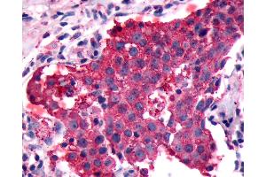 Anti-PGR1 / GPR153 antibody IHC of human Breast, Carcinoma. (GPR153 抗体  (Extracellular Domain))
