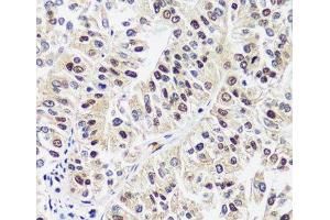 Immunohistochemistry of paraffin-embedded Human uterine cancer using CAND1 Polyclonal Antibody at dilution of 1:100 (40x lens). (CAND1 抗体)