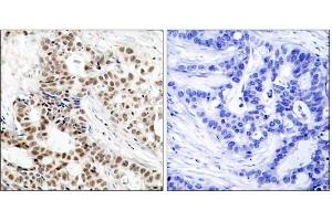 Immunohistochemical analysis of paraffin-embedded human breast carcinoma tissue, using BRCA1 (phospho-Ser1423) antibody (E011242). (BRCA1 抗体  (pSer1423))