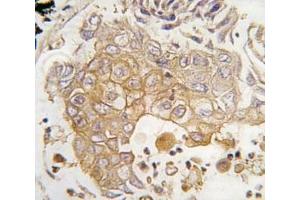 IHC analysis of FFPE human lung carcinoma tissue stained with CYP1A1 antibody (CYP1A1 抗体  (AA 377-405))