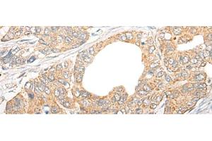 Immunohistochemistry of paraffin-embedded Human gastric cancer tissue using CCL5 Polyclonal Antibody at dilution of 1:50(x200) (CCL5 抗体)