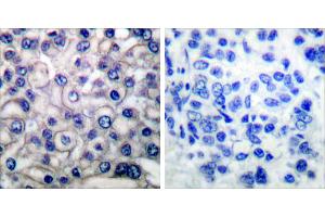 Peptide - +Immunohistochemical analysis of paraffin-embedded human breast carcinoma tissue using EGFR (Ab-693) antibody (#B0009). (EGFR 抗体  (Thr693))
