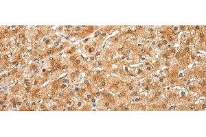 Immunohistochemistry of paraffin-embedded Human liver cancer tissue using DRD3 Polyclonal Antibody at dilution of 1:25(x200) (DRD3 抗体)