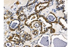 ABIN6257125 and ABIN6274536 at 1/100 staining human ovarian cancer by IHC-P. (DBF4 抗体  (Internal Region))