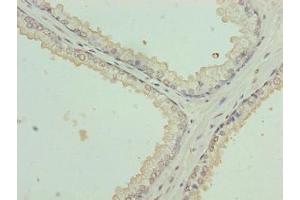 Immunohistochemistry of paraffin-embedded human prostate cancer using ABIN7157364 at dilution of 1:100 (Keratin 35 抗体  (AA 1-455))