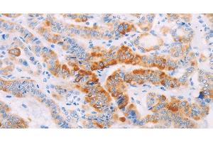 Immunohistochemistry of paraffin-embedded Human thyroid cancer using MAP4K3 Polyclonal Antibody at dilution of 1:30 (MAP4K3 抗体)