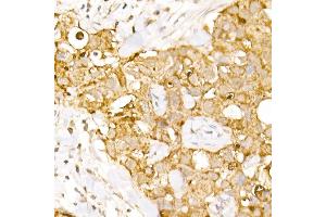 Immunohistochemistry of paraffin-embedded human breast cancer using B1 Rabbit pAb (ABIN6129916, ABIN6136962, ABIN6136963 and ABIN6222795) at dilution of 1:150 (40x lens). (AP3B1 抗体  (AA 895-1094))