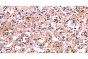 Immunohistochemistry of paraffin-embedded Human thyroid cancer tissue using PTPN13 Polyclonal Antibody at dilution 1:30 (PTPN13 抗体)
