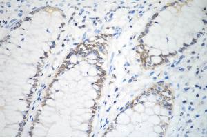 Immunohistochemistry was performed on paraffin-embedded human sigmoid colon carcinoma using DNA PKcs antibody (ABIN7800013), 1:200).