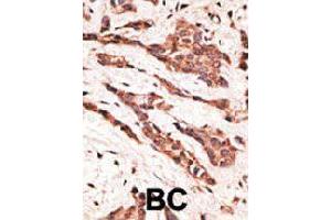 Formalin-fixed and paraffin-embedded human cancer tissue reacted with LPAR2 polyclonal antibody  , which was peroxidase-conjugated to the secondary antibody, followed by AEC staining. (EDG4 抗体  (N-Term))