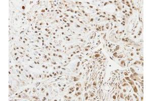 IHC-P Image Immunohistochemical analysis of paraffin-embedded A549 xenograft, using UBE2L3, antibody at 1:100 dilution.