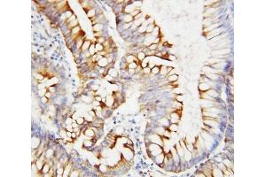 IHC-P: SPARC antibody testing of human intestinal cancer tissue (SPARC 抗体  (AA 284-303))