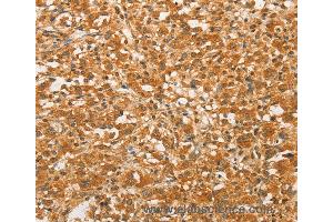 Immunohistochemistry of Human colon cancer using BCL2L14 Polyclonal Antibody at dilution of 1:40 (BCL2L14 抗体)