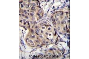 CBLN2 Antibody (C-term) (ABIN655780 and ABIN2845215) immunohistochemistry analysis in formalin fixed and paraffin embedded human breast carcinoma followed by peroxidase conjugation of the secondary antibody and DAB staining. (CBLN2 抗体  (C-Term))