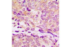 Immunohistochemical analysis of HSP90 alpha staining in human breast cancer formalin fixed paraffin embedded tissue section.