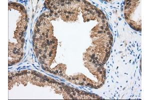 Immunohistochemical staining of paraffin-embedded Adenocarcinoma of Human ovary tissue using anti-TACC3 mouse monoclonal antibody. (TACC3 抗体)