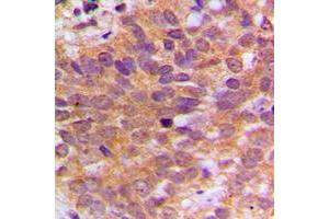 Immunohistochemical analysis of ABL1 staining in human breast cancer formalin fixed paraffin embedded tissue section. (ABL1 抗体  (C-Term))