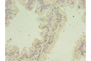 Immunohistochemistry of paraffin-embedded human prostate cancer using ABIN7174153 at dilution of 1:100 (SNRPB2 抗体  (AA 1-225))