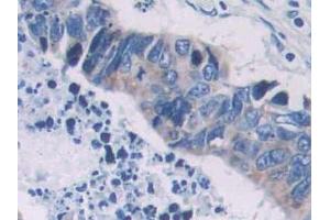IHC-P analysis of Human Colorectal cancer Tissue, with DAB staining. (PCOLCE 抗体  (AA 315-437))