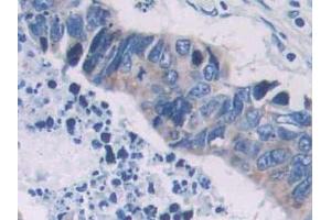 IHC-P analysis of Human Colorectal cancer Tissue, with DAB staining.
