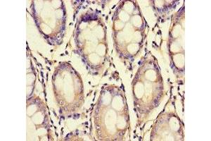 Immunohistochemistry of paraffin-embedded human colon cancer using ABIN7175909 at dilution of 1:100 (XPNPEP1 抗体  (AA 2-623))