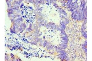 Immunohistochemistry of paraffin-embedded human ovarian cancer using ABIN7157975 at dilution of 1:100 (Leiomodin 1 抗体  (AA 29-187))