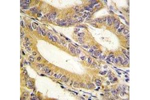 IHC analysis of FFPE human colon carcinoma tissue stained with XIAP antibody (XIAP 抗体  (AA 1-30))