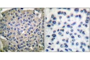 Immunohistochemistry analysis of paraffin-embedded human breast carcinoma, using Cortactin (Phospho-Tyr466) Antibody. (Cortactin 抗体  (pTyr466))