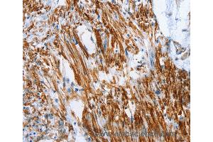 Immunohistochemistry of Human cervical cancer using SHROOM2 Polyclonal Antibody at dilution of 1:50 (SHROOM2 抗体)