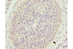 Immunohistochemistry of paraffin-embedded human cervical cancer using ABIN7158965 at dilution of 1:100 (Mammaglobin A 抗体  (AA 1-93))