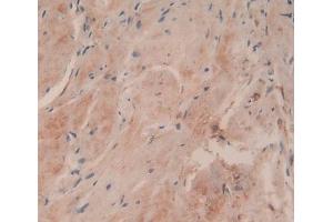 IHC-P analysis of Human Breast Cancer Tissue, with DAB staining. (COL6a3 抗体  (AA 463-624))