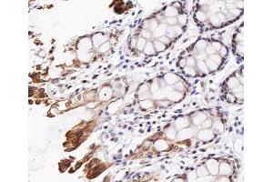 ABIN6267473 at 1/200 staining human colon cancer tissue sections by IHC-P. (AKT1 抗体  (pThr308))