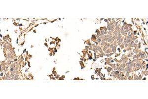 Immunohistochemistry of paraffin-embedded Human lung cancer tissue using SOX3 Polyclonal Antibody at dilution of 1:50(x200) (SOX3 抗体)