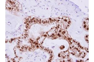 IHC-P Image DNAJB2 antibody detects DNAJB2 protein at cytosol on human ovarian Carcinoma by immunohistochemical analysis. (DNAJB2 抗体  (Center))