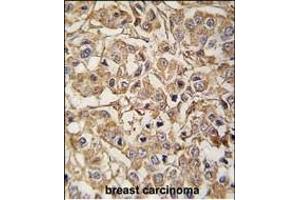 Formalin-fixed and paraffin-embedded human breast carcinoma tissue reacted with MYLK3 antibody (N-term) (ABIN392494 and ABIN2837985) , which was peroxidase-conjugated to the secondary antibody, followed by DAB staining. (MYLK3 抗体  (N-Term))