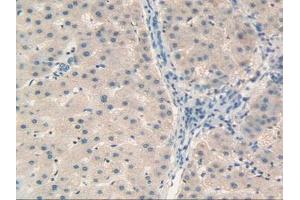 IHC-P analysis of Human Liver Cancer Tissue, with DAB staining. (Retinol Binding Protein 5 抗体  (AA 2-135))